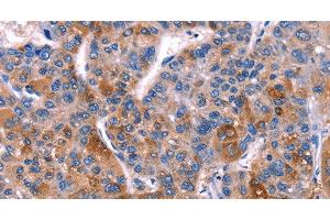 Immunohistochemistry of paraffin-embedded Human liver cancer tissue using DUSP13 Polyclonal Antibody at dilution 1:60 (DUSP13 抗体)