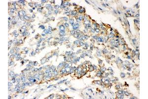 Anti- WNT2B Picoband antibody, IHC(P) IHC(P): Human Lung Cancer Tissue (WNT2B 抗体  (N-Term))