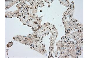 Immunohistochemical staining of paraffin-embedded Adenocarcinoma of breast tissue using anti-BUB1B mouse monoclonal antibody. (BUB1B 抗体)