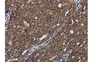 The image on the left is immunohistochemistry of paraffin-embedded Human ovarian cancer tissue using ABIN7190993(HOXC8 Antibody) at dilution 1/20, on the right is treated with synthetic peptide. (HOXC8 抗体)