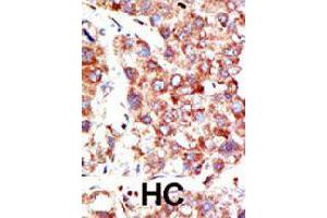 Formalin-fixed and paraffin-embedded human hepatocellular carcinoma tissue reacted with NEDD8 polyclonal antibody  , which was peroxidase-conjugated to the secondary antibody, followed by DAB staining. (NEDD8 抗体  (N-Term))