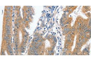 Immunohistochemistry of paraffin-embedded Human colon cancer tissue using CENPC Polyclonal Antibody at dilution 1:70 (Centromere Protein C Pseudogene 1 (CENPCP1) 抗体)