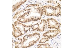 Immunohistochemistry of paraffin-embedded human colon carcinoma using TCE Rabbit mAb (ABIN7270877) at dilution of 1:25 (40x lens).