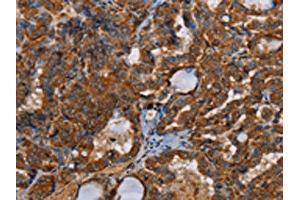 The image on the left is immunohistochemistry of paraffin-embedded Human thyroid cancer tissue using ABIN7191964(POU6F2 Antibody) at dilution 1/30, on the right is treated with synthetic peptide. (POU6F2 抗体)