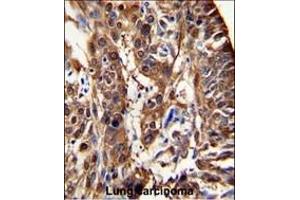 Formalin-fixed and paraffin-embedded human lung carcinoma reacted with ALDH3A1 Antibody (N-term), which was peroxidase-conjugated to the secondary antibody, followed by DAB staining. (ALDH3A1 抗体  (N-Term))