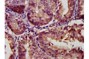 IHC image of ABIN7153467 diluted at 1:300 and staining in paraffin-embedded human endometrial cancer performed on a Leica BondTM system. (Galectin 9 抗体  (AA 1-323))