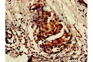 Immunohistochemistry of paraffin-embedded human breast cancer using ABIN7157103 at dilution of 1:100 (ISOC1 抗体  (AA 155-298))