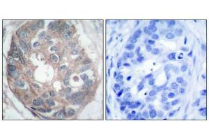 Immunohistochemical analysis of paraffin-embedded human breast carcinoma tissue using Dab1(Ab-232) Antibody(left) or the same antibody preincubated with blocking peptide(right). (DAB1 抗体)