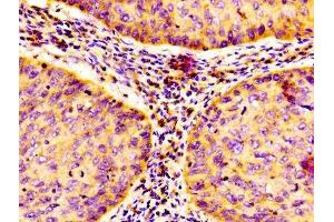 IHC image of ABIN7161781 diluted at 1:100 and staining in paraffin-embedded human cervical cancer performed on a Leica BondTM system. (NFKB1 抗体  (AA 1-961))