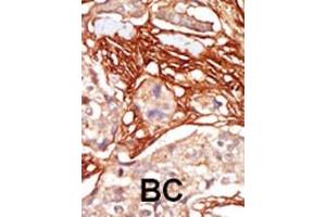 Formalin-fixed and paraffin-embedded human cancer tissue reacted with the primary antibody, which was peroxidase-conjugated to the secondary antibody, followed by AEC staining. (ARAF 抗体  (AA 256-286))