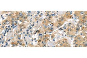 Immunohistochemistry of paraffin-embedded Human liver cancer using UTS2B Polyclonal Antibody at dilution of 1/35 (Urotensin 2B 抗体)