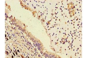 Immunohistochemistry of paraffin-embedded human lung cancer using ABIN7163357 at dilution of 1:100 (PPAP2B 抗体  (AA 144-193))