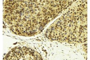 ABIN6274283 at 1/100 staining Human breast cancer tissue by IHC-P. (RBM5 抗体  (N-Term))