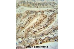 CUL5 Antibody (C-term) (ABIN391834 and ABIN2841675) immunohistochemistry analysis in formalin fixed and paraffin embedded human colon carcinoma followed by peroxidase conjugation of the secondary antibody and DAB staining. (Cullin 5 抗体  (C-Term))