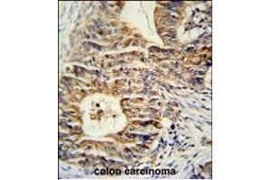 KLHL24 Antibody (Center) (ABIN651431 and ABIN2840236) immunohistochemistry analysis in formalin fixed and paraffin embedded human colon carcinoma followed by peroxidase conjugation of the secondary antibody and DAB staining. (Kelch-Like 24 抗体  (AA 182-211))