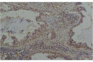 Immunohistochemistry of paraffin-embedded Human lung carcinoma tissue with Phosphoserine Monoclonal Antibody at dilution of 1:200 (Phosphoserine 抗体)