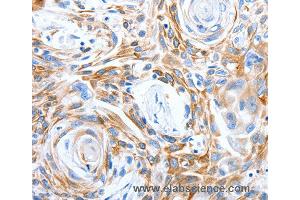 Immunohistochemistry of Human esophagus cancer using LRIG3 Polyclonal Antibody at dilution of 1:50 (LRIG3 抗体)