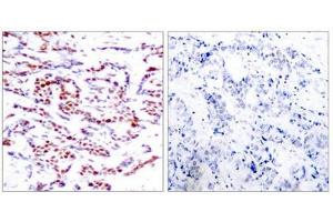 Immunohistochemical analysis of paraffin-embedded human breast carcinoma tissue using ATF2(Phospho-Thr71 or 53) Antibody(left) or the same antibody preincubated with blocking peptide(right). (ATF2 抗体  (pThr71))