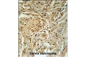BLOC1S2 Antibody (Center) (ABIN651729 and ABIN2840378) immunohistochemistry analysis in formalin fixed and paraffin embedded human cervix carcinoma followed by peroxidase conjugation of the secondary antibody and DAB staining.