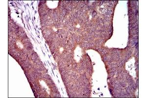 Immunohistochemical analysis of paraffin-embedded rectum cancer tissues using PDE1B mouse mAb with DAB staining. (PDE1B 抗体  (AA 370-536))