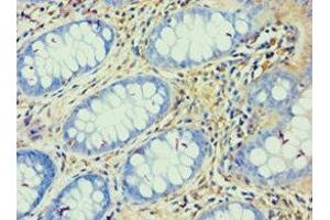 Immunohistochemistry of paraffin-embedded human colon cancer using ABIN7144823 at dilution of 1:100
