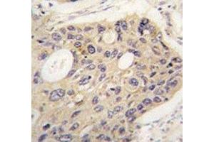 IHC analysis of FFPE human lung carcinoma tissue stained with ATG12 antibody (ATG12 抗体)