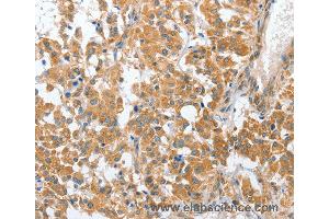 Immunohistochemistry of Human liver cancer using CHMP4B Polyclonal Antibody at dilution of 1:40 (CHMP4B 抗体)