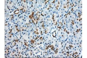 Immunohistochemical staining of paraffin-embedded Adenocarcinoma of Human ovary tissue using anti-BDH2 mouse monoclonal antibody. (BDH2 抗体)