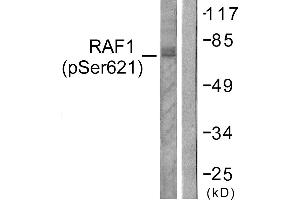 Immunohistochemistry analysis of paraffin-embedded human lung carcinoma tissue using Raf1 (Phospho-Ser621) antibody. (RAF1 抗体  (pSer621))