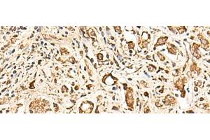 Immunohistochemistry of paraffin-embedded Human prost ate cancer tissue using SOX3 Polyclonal Antibody at dilution of 1:50(x200) (SOX3 抗体)