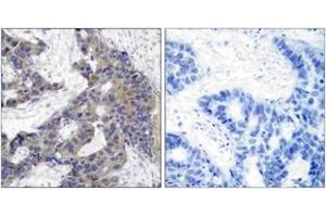 Immunohistochemistry analysis of paraffin-embedded human breast carcinoma tissue, using JAK2 (Ab-1007) Antibody. (JAK2 抗体  (AA 981-1030))