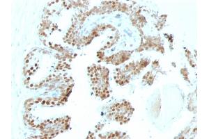 Formalin-fixed, paraffin-embedded human Prostate Carcinoma stained with p57 Mouse Monoclonal Antibody (SPM308). (CDKN1C 抗体)