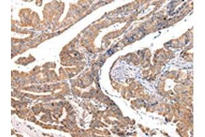 The image on the left is immunohistochemistry of paraffin-embedded Human esophagus cancer tissue using ABIN7190330(COL8A2 Antibody) at dilution 1/20, on the right is treated with synthetic peptide. (COL8a2 抗体)
