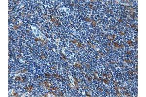 Immunohistochemical staining of paraffin-embedded Human lymphoma tissue using anti-MICAL1 mouse monoclonal antibody. (MICAL1 抗体)