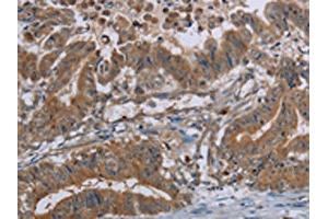 The image on the left is immunohistochemistry of paraffin-embedded Human esophagus cancer tissue using ABIN7130067(LCMT1 Antibody) at dilution 1/20, on the right is treated with fusion protein. (LCMT1 抗体)