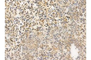 ABIN6265105 and ABIN6266826 at 1/100 staining human Hodgkin lymphoma by IHC-P.