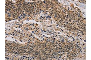 The image on the left is immunohistochemistry of paraffin-embedded Human cervical cancer tissue using ABIN7190296(CLEC5A Antibody) at dilution 1/20, on the right is treated with synthetic peptide. (CLEC5A 抗体)