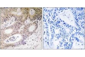 Immunohistochemistry analysis of paraffin-embedded human colon carcinoma tissue, using MSK1 (Ab-212) Antibody. (MSK1 抗体  (AA 181-230))