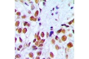 Immunohistochemical analysis of RAD54A staining in human breast cancer formalin fixed paraffin embedded tissue section. (RAD54L 抗体)