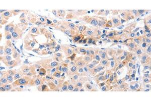 Immunohistochemistry of paraffin-embedded Human lung cancer using CDK7 Polyclonal Antibody at dilution of 1:30 (CDK7 抗体)