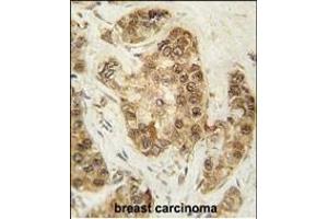 Formalin-fixed and paraffin-embedded human breast carcinoma tissue reacted with CDK2 Antibody (T14) (ABIN1881192 and ABIN2841623) , which was peroxidase-conjugated to the secondary antibody, followed by DAB staining. (CDK2 抗体  (AA 1-30))