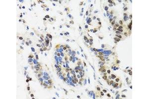 Immunohistochemistry of paraffin-embedded Human gastric cancer using TOP1 Polyclonal Antibody at dilution of 1:100 (40x lens). (Topoisomerase I 抗体)