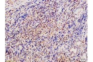 Formalin-fixed and paraffin embedded human nasopharyngeal carcinoma tissue labeled with Anti-Twist Polyclonal Antibody , Unconjugated at 1:200 followed by conjugation to the secondary antibody, (SP-0023), and DAB staining (TWIST1, TWIST2 (AA 71-170) 抗体)