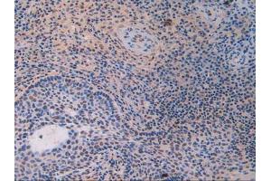 IHC-P analysis of Human Skin Cancer Tissue, with DAB staining. (IFI16 抗体  (AA 465-671))
