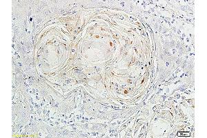 Formalin-fixed and paraffin-embedded human cervical carcinoma labeled with Rabbit Anti-Ki-67 Polyclonal Antibody, Unconjugated (ABIN677858) at 1:200 followed by conjugation to the secondary antibody and DAB staining