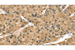 Immunohistochemistry of paraffin-embedded Human liver cancer tissue using STX8 Polyclonal Antibody at dilution 1:45 (STX8 抗体)