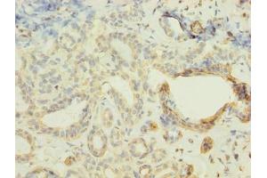 Immunohistochemistry of paraffin-embedded human breast cancer using ABIN7152421 at dilution of 1:100 (FBXO28 抗体  (AA 251-368))