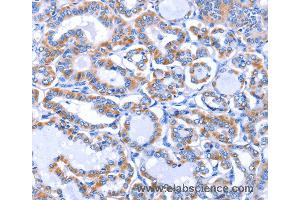 Immunohistochemistry of Human thyroid cancer using GJB3 Polyclonal Antibody at dilution of 1:30