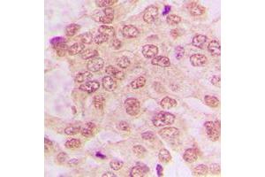 Immunohistochemical analysis of CDK2 staining in human lung cancer formalin fixed paraffin embedded tissue section. (CDK2 抗体  (C-Term))