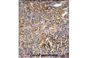 TANK Antibody (Center) (ABIN652041 and ABIN2840515) immunohistochemistry analysis in formalin fixed and paraffin embedded human cervix carcinoma followed by peroxidase conjugation of the secondary antibody and DAB staining. (TANK 抗体  (AA 88-114))